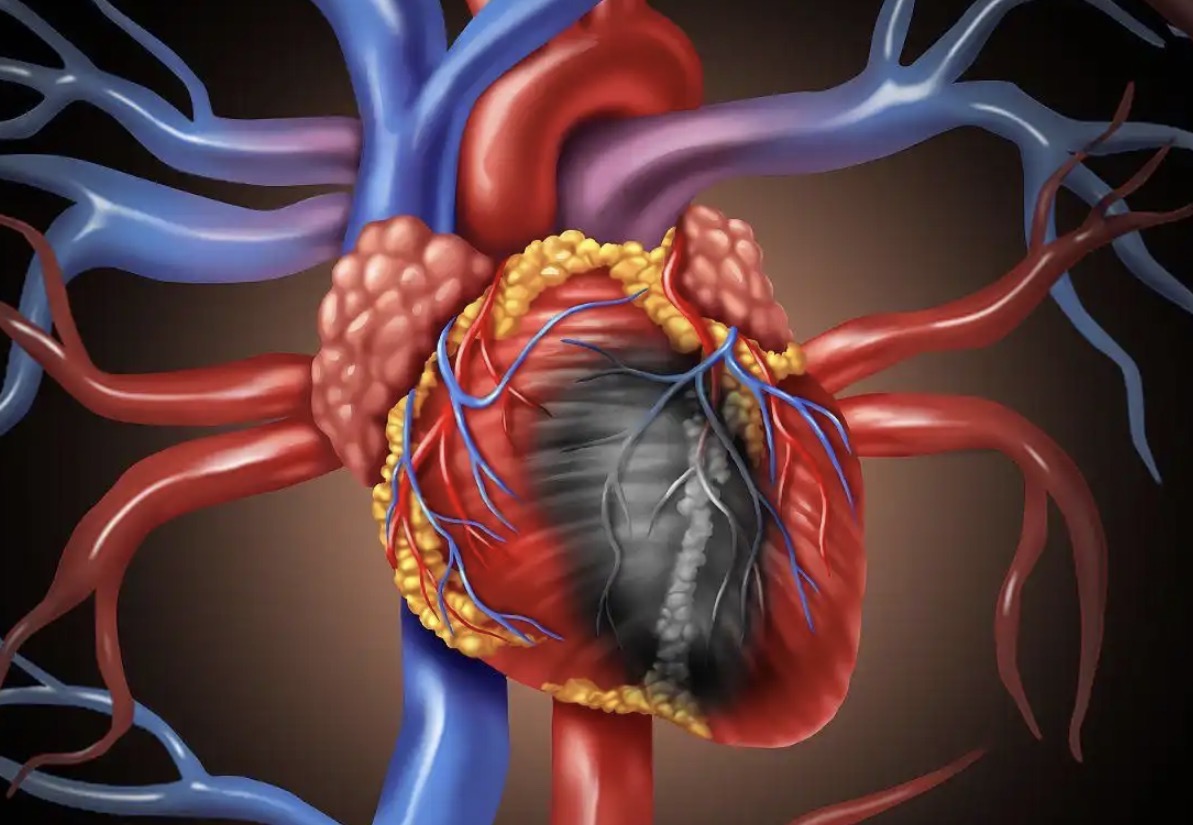 AI已能精准定位心梗病变血管，有望提供高效预警信号